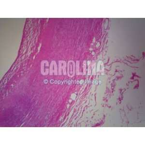 Human Atherosclerosis, Artery, sec. Microscope Slide, 7 u  