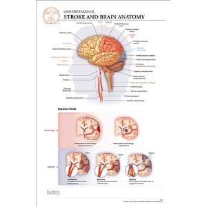   11 x 17 Post It Disease Chart STROKE & Brain Anatomy 