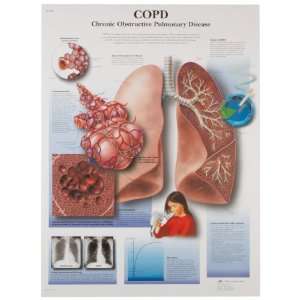  VR1329UU Glossy Paper Copd Chronic Obstructive Pulmonary Disease 
