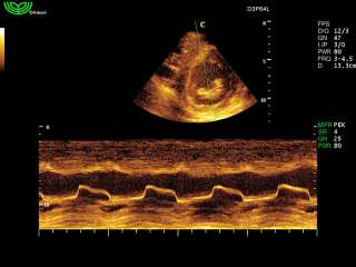 ECOCOLORDOPPER CHISON IVIS 60 EXPERT ECOGRAFO + 4D + SONDA CONVEX 